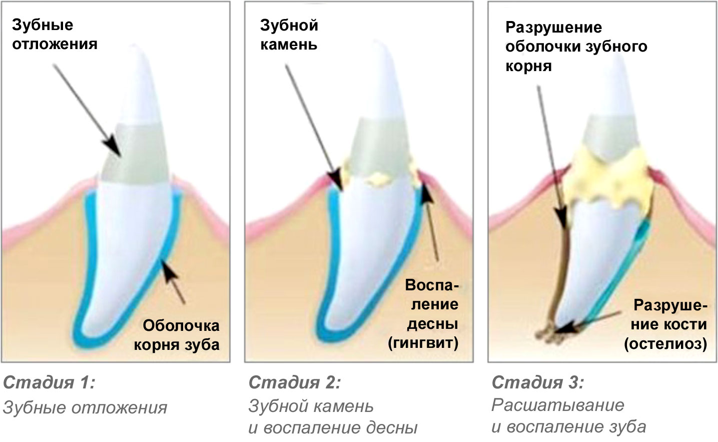Стадии пародонтального заболевания